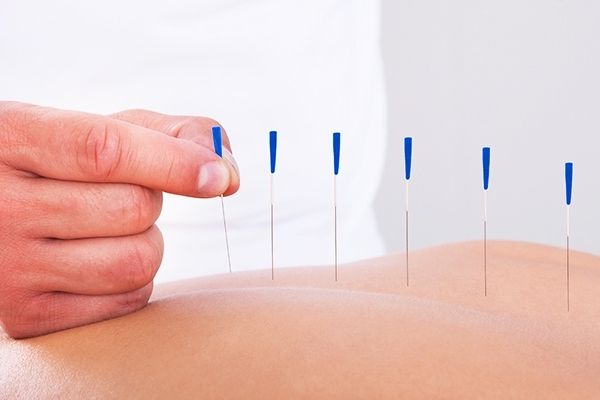 acupuntura
